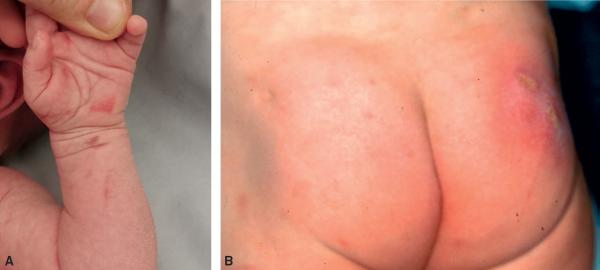 Fig. 10.1. Lésions ecchymotiques multiples de l’avant-bras et de la paume de la main (A). Brûlures de cigarette sur le siège (B).