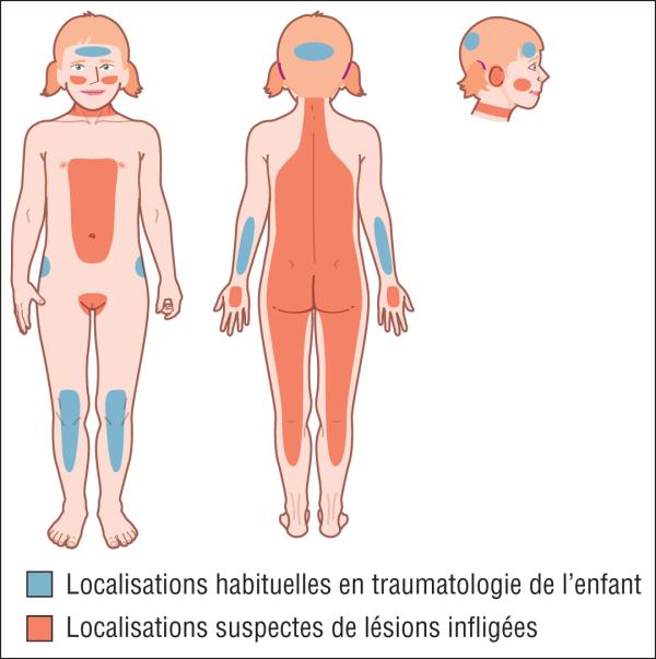 Fig. 10.2. Localisations suspectes de lésions infligées et localisations habituelles en traumatologie de l’enfant.