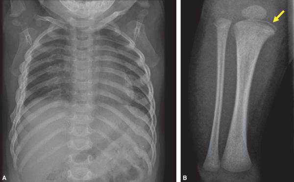 Fig. 10.3. Syndrome de Silverman.