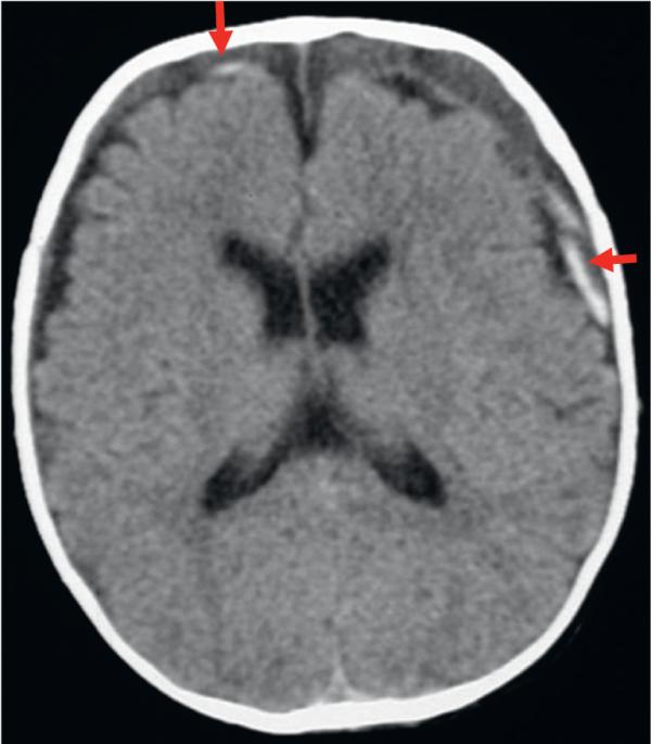 Fig. 10.7. Hématome sous-dural aigu frontopariétal bilatéral.