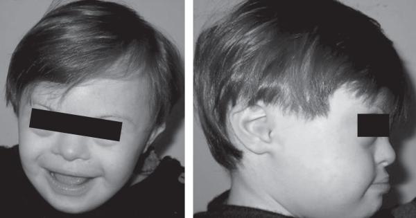 Fig. 12.1.   Trisomie 21 : dysmorphie craniofaciale.