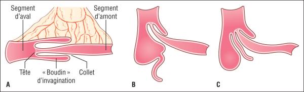 Fig. 17.1. <<icon03-9782294779831.eps>> Invagination intestinale aiguë.