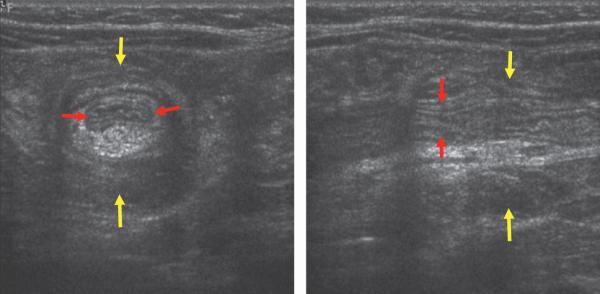 Fig. 17.2.  Invagination intestinale aiguë.