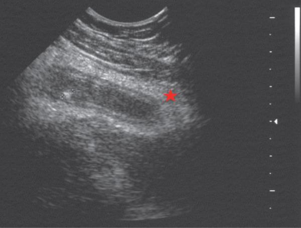 Fig. 17.3. Appendicite aiguë.