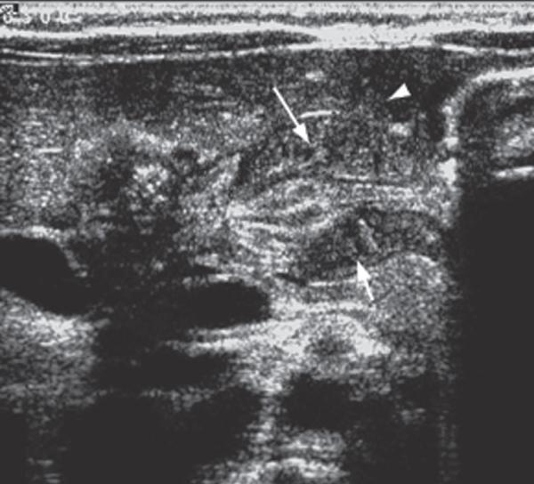 Fig. 18.2. Sténose hypertrophique du pylore.