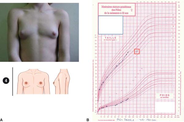 Fig. 2.2. Puberté précoce centrale débutée vers 7 ans chez une fille vue à l’âge de 8 ans.