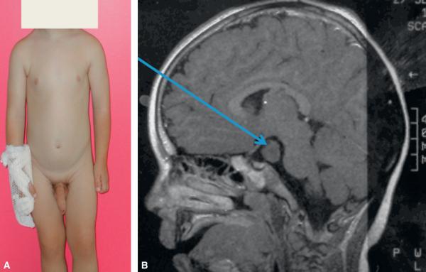 Fig. 2.3. Puberté précoce centrale chez un garçon âgé de 2 ans et 4 mois.