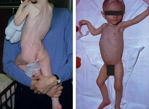 Fig. 20.2. Enfants dénutris dans un contexte de maladie cœliaque.