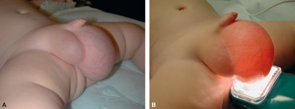 Fig. 22.4. Hydrocèle (avec transillumination).