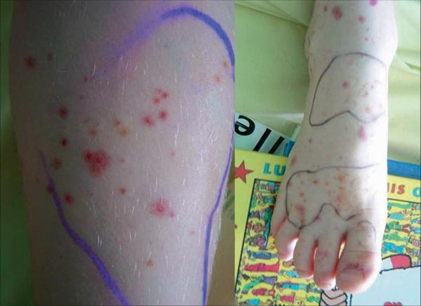 Fig. 24.3.  Purpura rhumatoïde.
