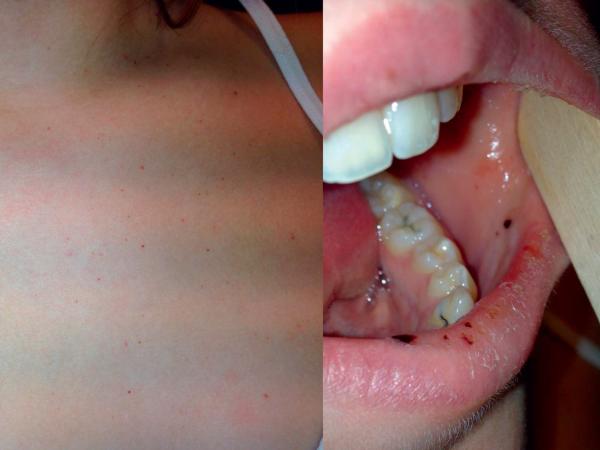 Fig. 24.5. < Purpura thrombopénique immunologique : pétéchies cuta-nées et buccales.