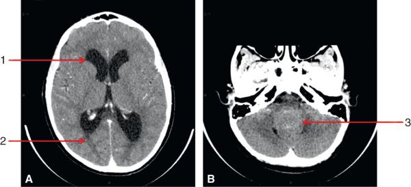 Fig. 27.2. TDM cérébrale réalisée en urgence devant un tableau d’HTIC.