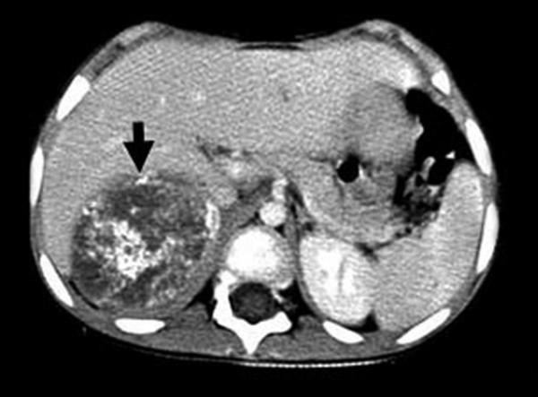 Fig. 27.4. Neuroblastome abdominal.