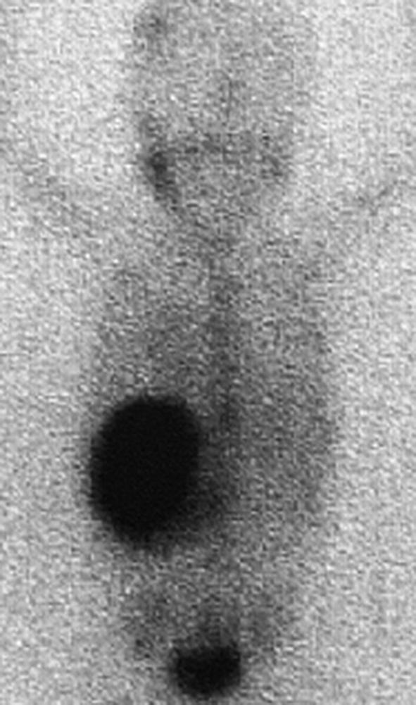 Fig. 27.4. Neuroblastome abdominal.