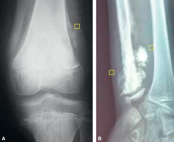 Fig. 27.6. Aspects radiographiques de tumeurs osseuses.