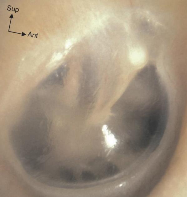 Fig. 32.2.  Tympan droit normal.