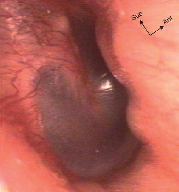 Fig. 32.3.  Otite congestive droite.