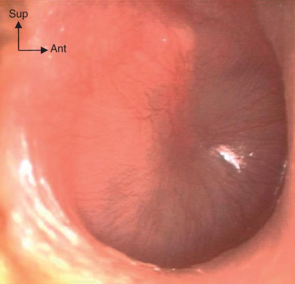 Fig. 32.4.  OMA purulente droite.