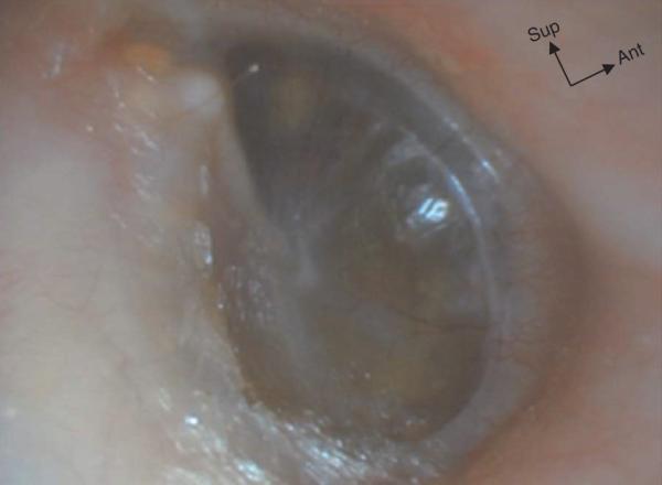 Fig. 32.5.  Otite séromuqueuse droite avec tympan opaque à peine rétracté, petites granulations jaunâtres.