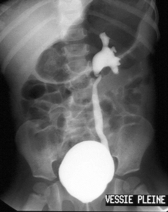 Fig. 36.1.  RVU de grade 3.