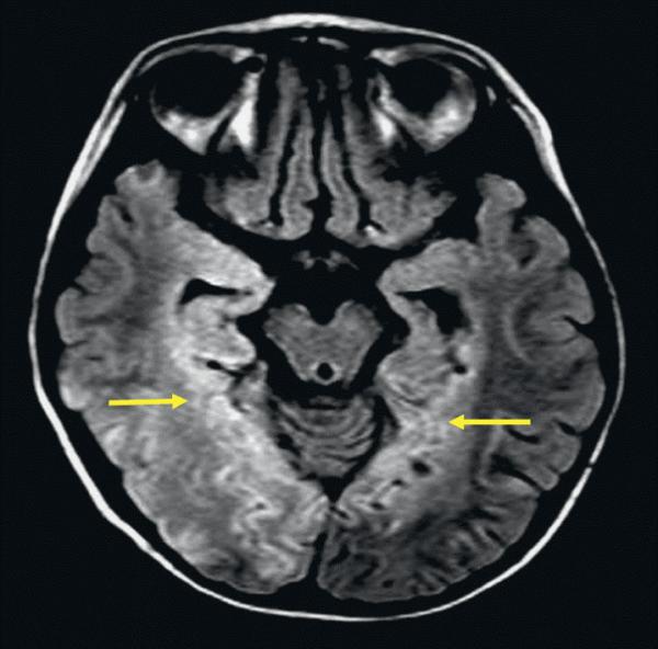 Fig. 37.3.  Lésions IRM d’encéphalite herpétique.