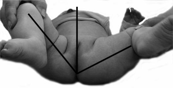 Fig. 4.5. Limitation d’abduction du côté droit.