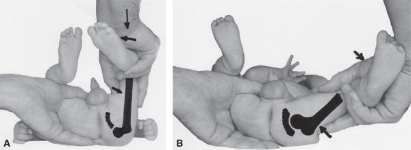 Fig. 4.6. Manœuvre de Barlow : examen de la hanche gauche d’un nourrisson.
