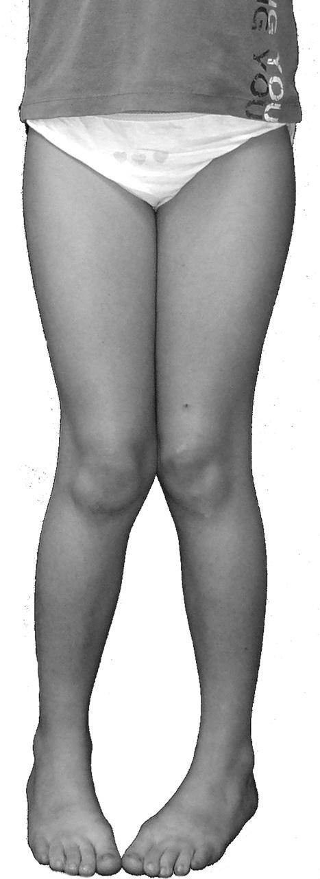Fig. 4.7. Morphotype en torsion interne.