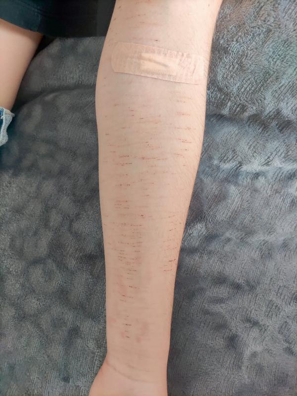 Fig. 43.1. Scarifications chez une adolescente.