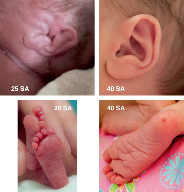 Fig. 44.11. Critères morphologiques de maturation : cartilage des oreilles, plis plantaires.