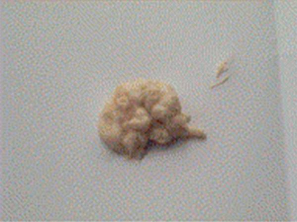 Fig. 45.5.   Selles complètement décolorées.