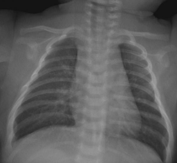 Fig. 56.1. Aspect radiographique de bronchiolite aiguë.