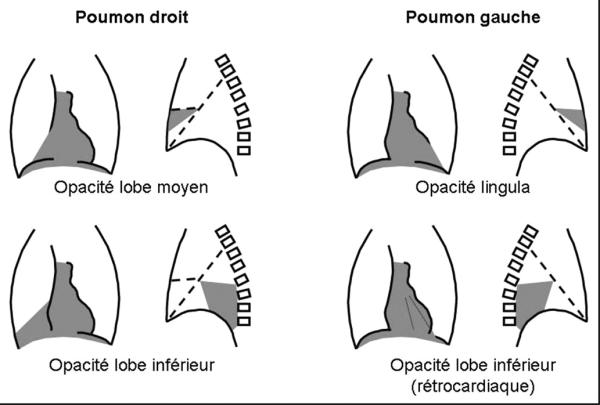 Fig. 59.1. Localisation de la pneumonie aiguë.