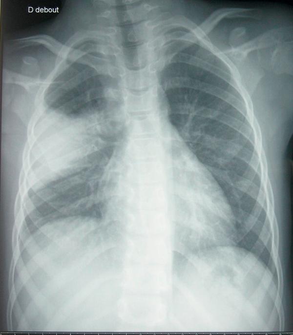 Fig. 59.2. Pneumonie franche lobaire aiguë droite.