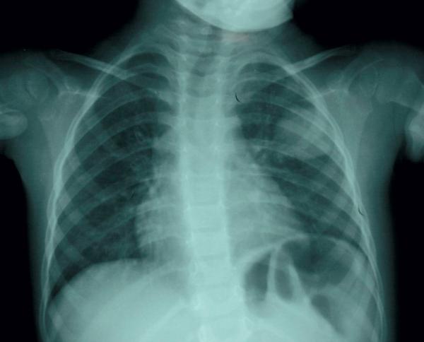 Fig. 59.3. Pneumonie ronde.