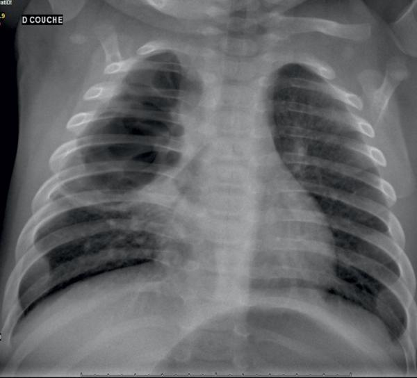 Fig. 59.4. Pleuropneumopathie à S. aureus.