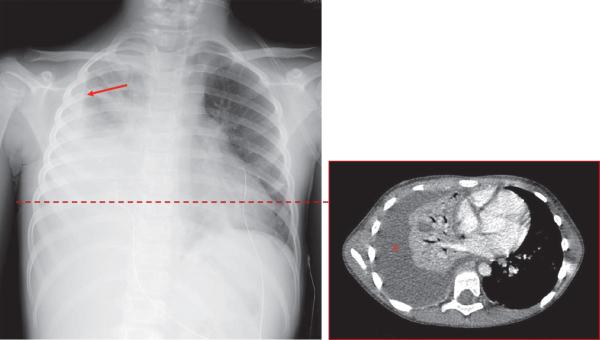 Fig. 59.5. Infection pleuropulmonaire.