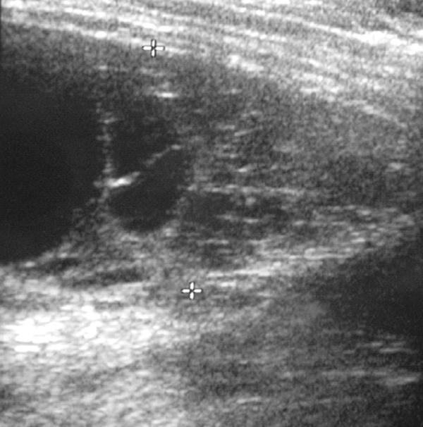 Fig. 59.6. Échographie thoracique d’un épanchement pleural cloisonné.