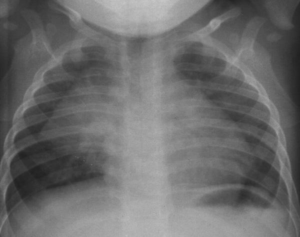 Fig. 60.2. Thymus chez un nourrisson.