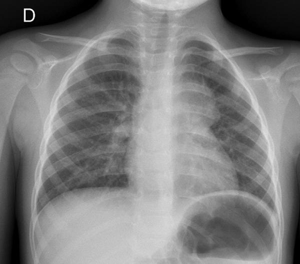 Fig. 60.5. Adénopathie médiastinale gauche.