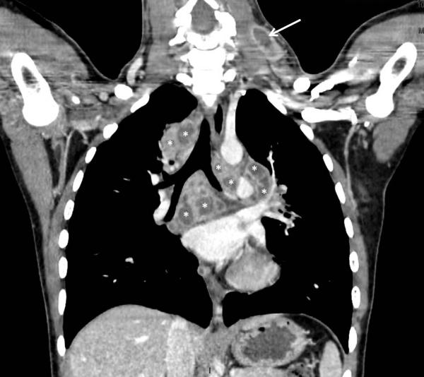 Fig. 61.2. Scanner thoracique.