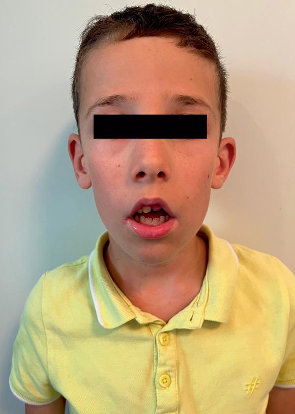 Fig. 62.1. Faciès adénoïdien.