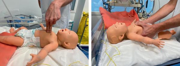 Fig. 65.3.  Compressions thoraciques chez le nourrisson.