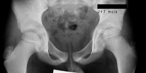 Fig. 70.3. Radiographie du bassin : séquelle d’arthrite septique de hanche.