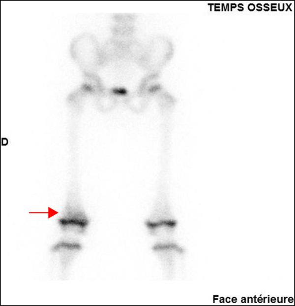 Fig. 70.5. Cliché de scintigraphie osseuse. Temps osseux.