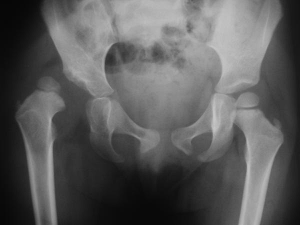 Fig. 70.6. Radiographie du bassin : luxation congénitale de hanche droite chez une fille de 16 mois.