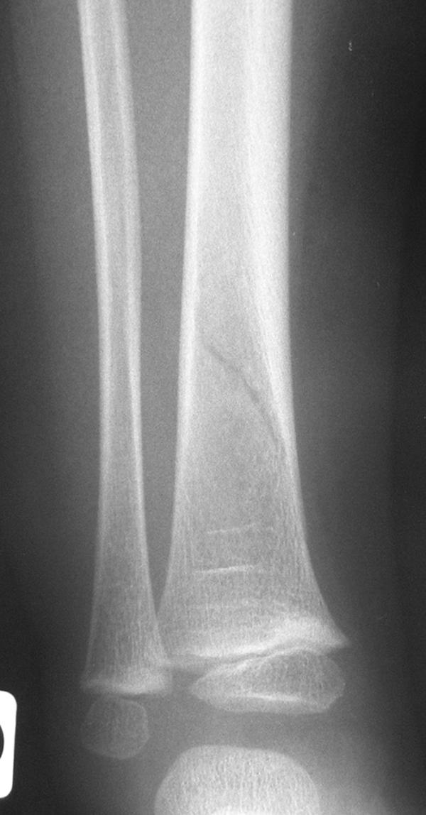 Fig. 70.7. Radiographie du membre inférieur : fracture sous-périostée chez une fille de 2 ans