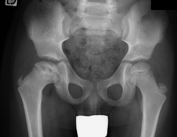 Fig. 70.8. Radiographie du bassin : ostéochondrite primitive de la hanche droite chez un garçon de 7 ans.