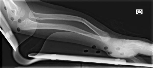 Fig. 71.1.  Fracture plastique des deux os de l’avant-bras.