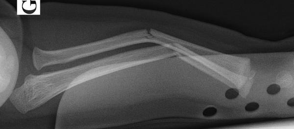 Fig. 71.2.  Fracture en « bois vert ».